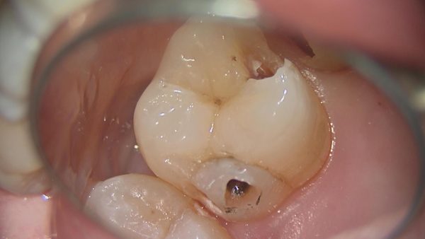 甲子園あいはら歯科医院でのセラミック治療中（銀歯の除去）