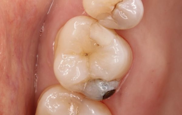 甲子園あいはら歯科医院でのセラミック治療術前（銀歯