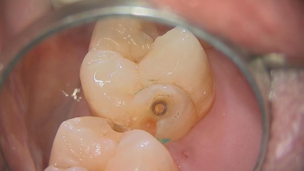 マイクロスコープで精密にむし歯除去