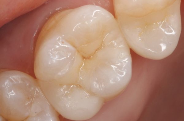 甲子園あいはら歯科医院でのセラミック治療術後（e-max）