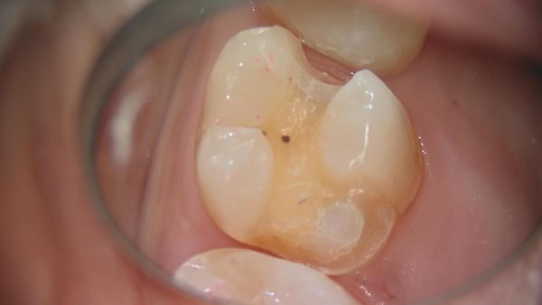 マイクロスコープで精密に整えられたセラミックの土台（マージン）